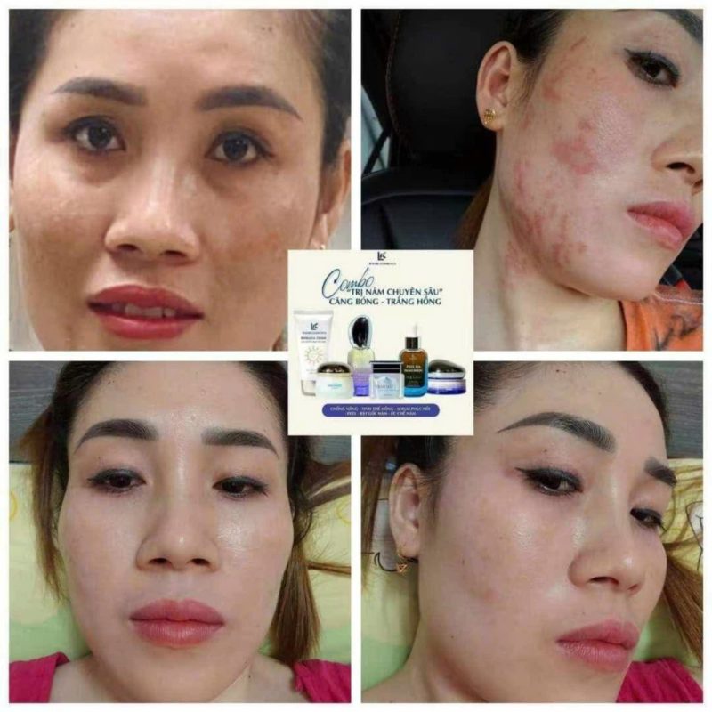 lkaori trị nám 2025-03-14-1