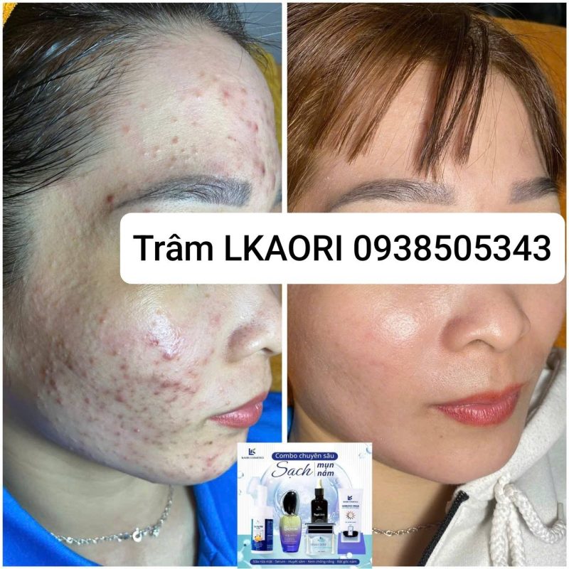 mỹ phẩm lkaori trị mụn 2025-02-13-1