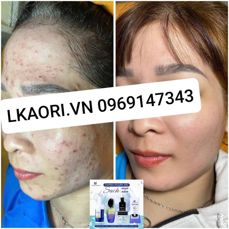 mỹ phẩm lkaori trị mụn 2025-02-13-2