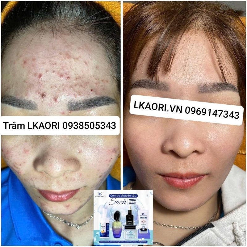 mỹ phẩm lkaori trị mụn 2025-02-13-1
