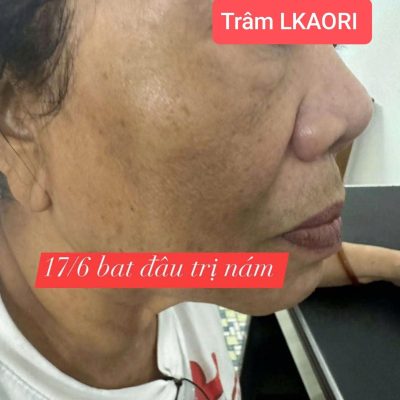 mỹ phẩm lkaori trị nám 2025-02-24-1