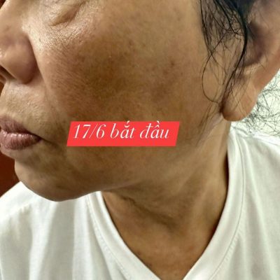 mỹ phẩm lkaori trị nám 2025-02-24-2