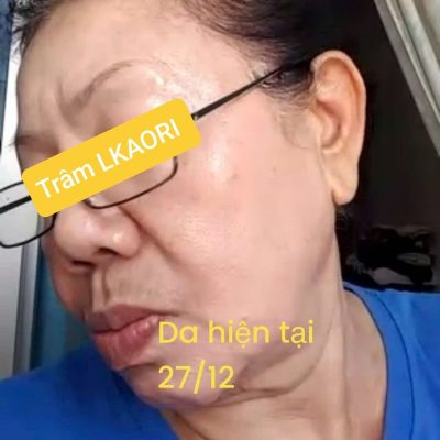mỹ phẩm lkaori trị nám 2025-02-24-4
