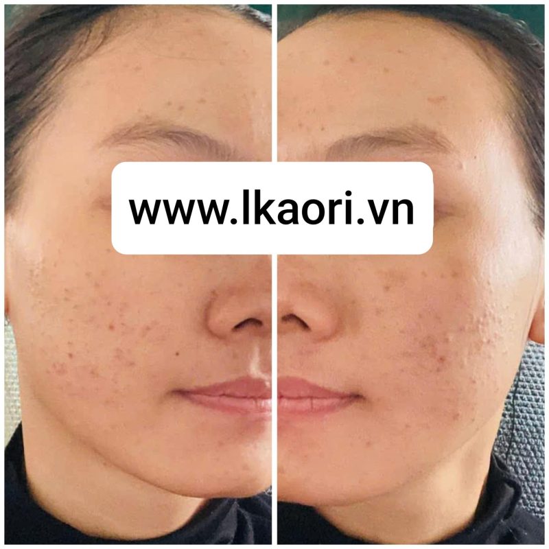 Trâm Lkaori trị mụn 2025-03-16-1