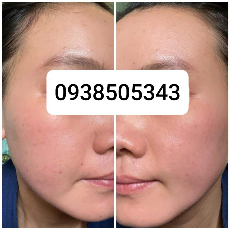 Trâm Lkaori trị mụn 2025-03-16-2