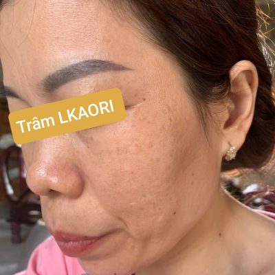 Trâm Lkaori trị nám 2025-6-3-1