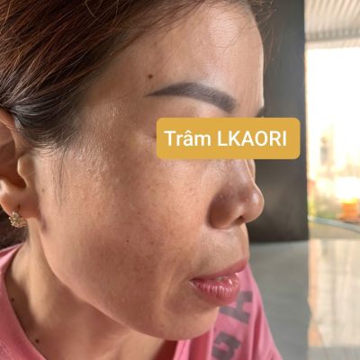 Trâm Lkaori trị nám 2025-6-3-2