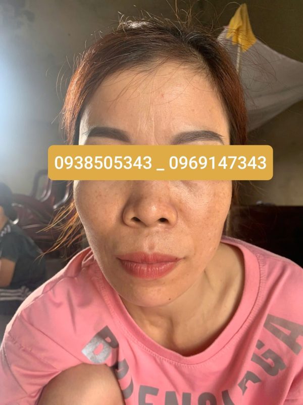 Trâm Lkaori trị nám 2025-6-3-3
