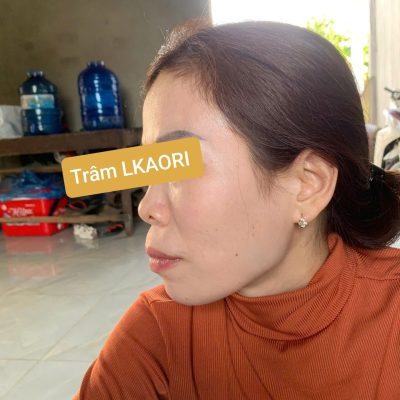 Trâm Lkaori trị nám 2025-6-3-5